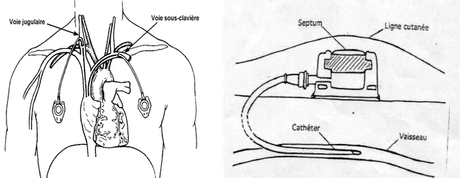 cathéter à chambre implantable