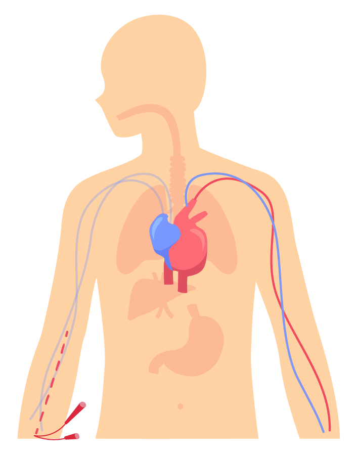 Les voies d'abords et accessoires de cathétérisation Perfusion à domicile