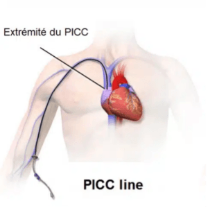 positionnement distal idéal