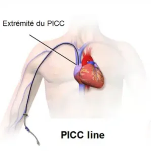 positionnement distal idéal